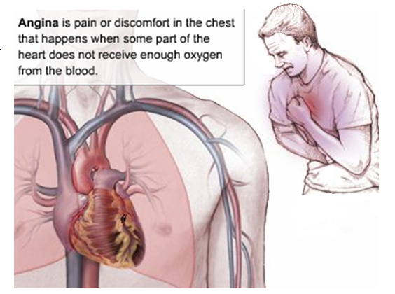Angina Pectoralis