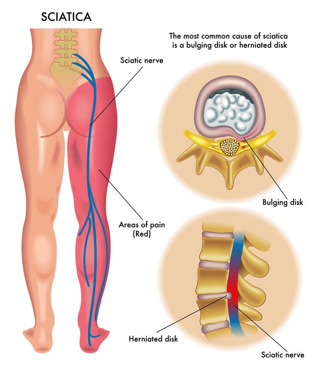 Causes of sciatica